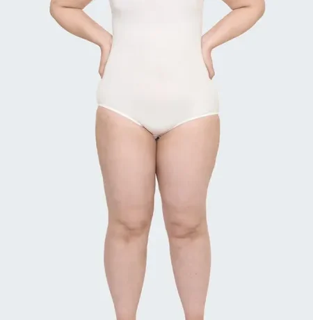lipedema-grado-1